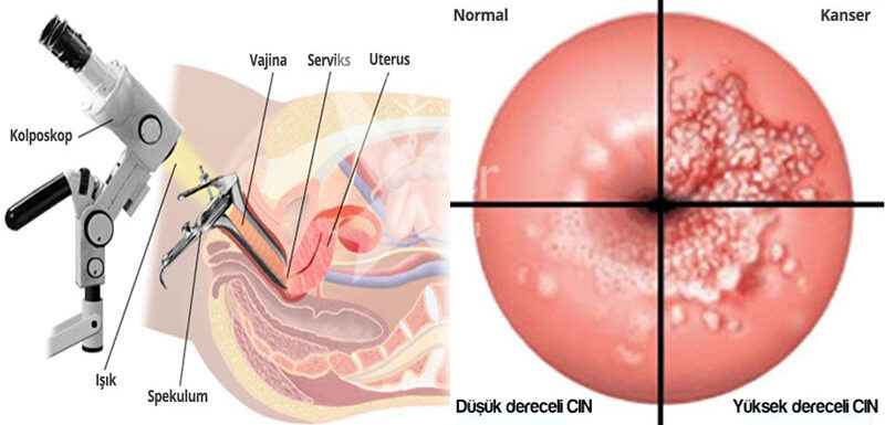 hpv kolposkopi nedir a genitális szemölcsök kriodestrukciója hogyan lehet gyógyítani