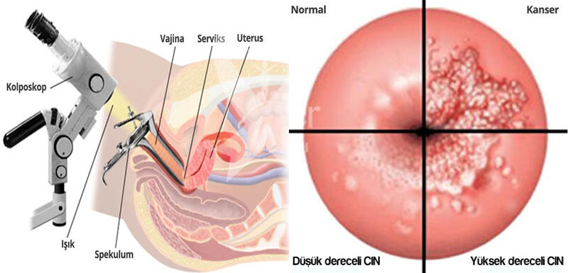 hpv kolposkopi nedir